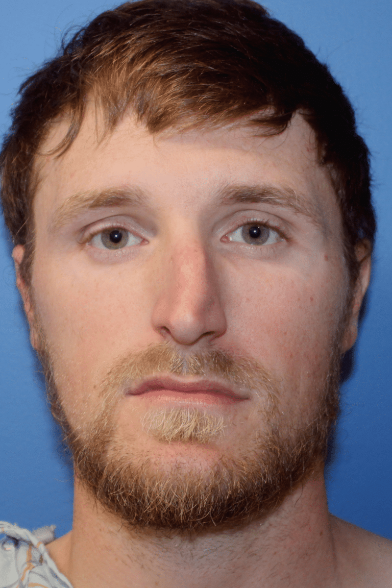 Real patient Rhinoplasty by Dr.Somenek, Washington D.C.
