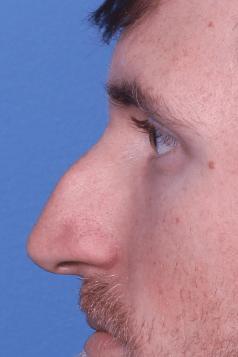 Real patient Rhinoplasty by Dr.Somenek, Washington D.C.