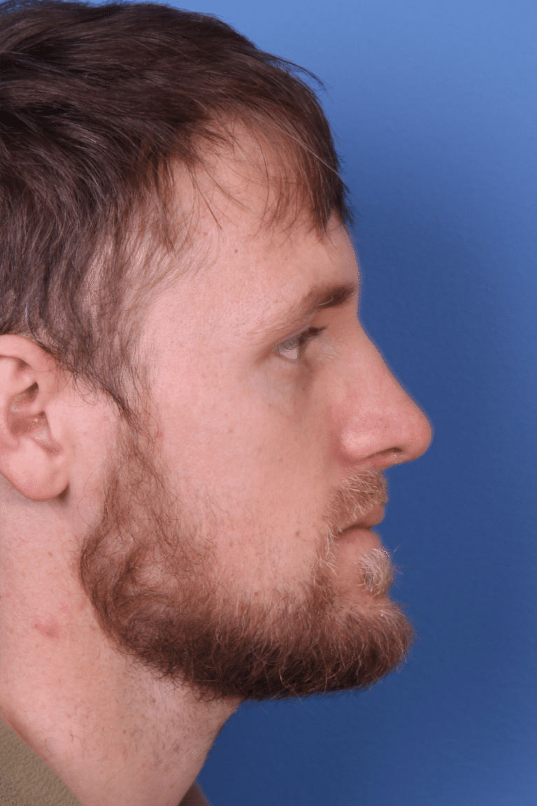 Real patient Rhinoplasty by Dr.Somenek, Washington D.C.