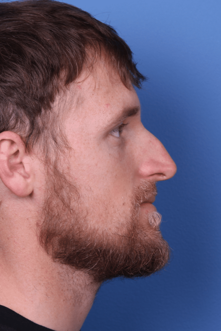 Real patient Rhinoplasty by Dr.Somenek, Washington D.C.