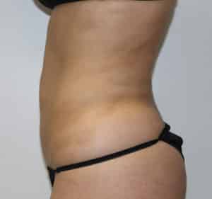 Real Patient Trusculpt ID, Somenek + Pittman MD, Washington D.C.