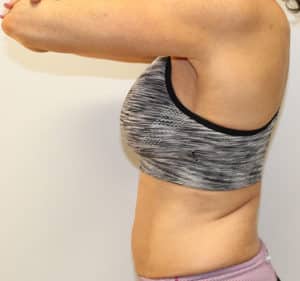 Real Patient Trusculpt ID, Somenek + Pittman MD, Washington D.C.