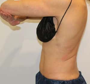 Real Patient Trusculpt ID, Somenek + Pittman MD, Washington D.C.