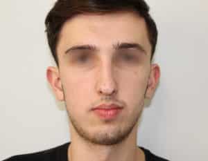 Real patient Rhinoplasty by Dr.Somenek, Washington D.C.