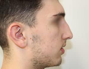 Real patient Rhinoplasty by Dr.Somenek, Washington D.C.