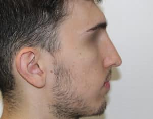 Real patient Rhinoplasty by Dr.Somenek, Washington D.C.