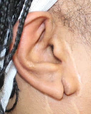 Real patient Earlobe Repair by Dr.Somenek, Washington D.C.