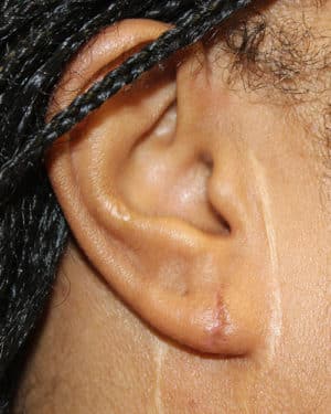Real patient Earlobe Repair by Dr.Somenek, Washington D.C.