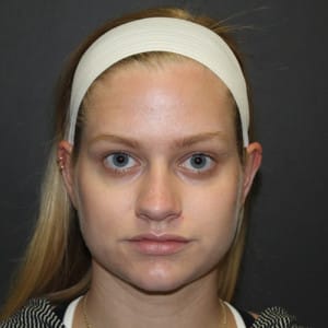 Real patient Rhinoplasty by Dr.Somenek, Washington D.C.