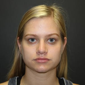 Real patient Rhinoplasty by Dr.Somenek, Washington D.C.