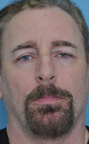 Real patient Rhinoplasty by Dr.Somenek, Washington D.C.