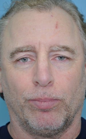 Real patient Rhinoplasty by Dr.Somenek, Washington D.C.