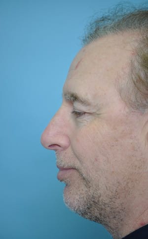 Real patient Rhinoplasty by Dr.Somenek, Washington D.C.
