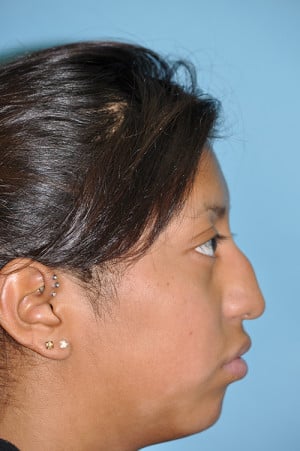 Real patient Rhinoplasty by Dr.Somenek, Washington D.C.