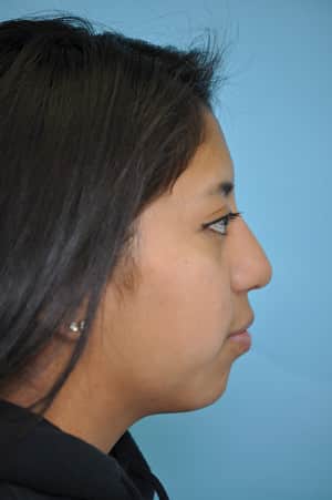 Real patient Rhinoplasty by Dr.Somenek, Washington D.C.