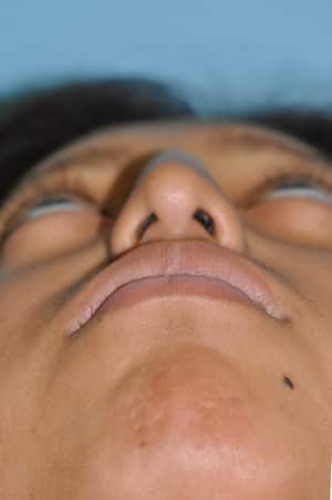Real patient Rhinoplasty by Dr.Somenek, Washington D.C.