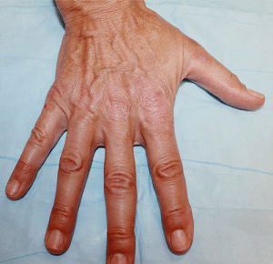 Real Patient Hand Rejuvenation, Somenek + Pittman MD, Washington D.C.
