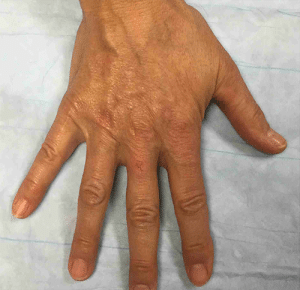 Real Patient Hand Rejuvenation, Somenek + Pittman MD, Washington D.C.