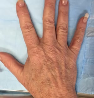 Real Patient Hand Rejuvenation, Somenek + Pittman MD, Washington D.C.