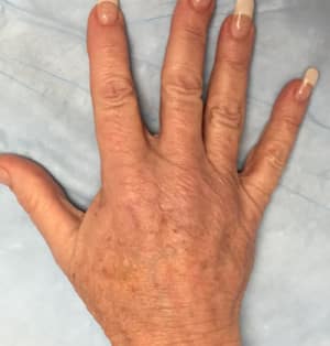 Real Patient Hand Rejuvenation, Somenek + Pittman MD, Washington D.C.