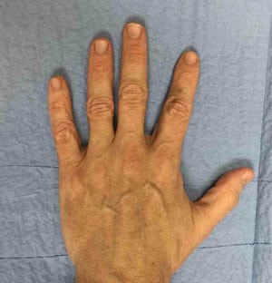 Real Patient Hand Rejuvenation, Somenek + Pittman MD, Washington D.C.