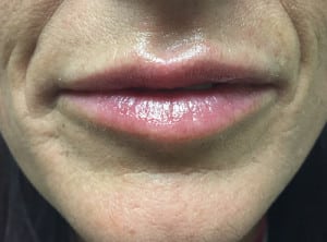 Real Patient Lip Augmentation, Somenek + Pittman MD, Washington D.C.