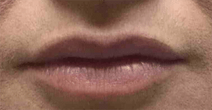 Real Patient Lip Augmentation, Somenek + Pittman MD, Washington D.C.