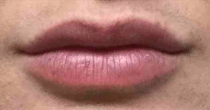 Real Patient Lip Augmentation, Somenek + Pittman MD, Washington D.C.