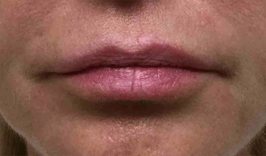 Real Patient Lip Augmentation, Somenek + Pittman MD, Washington D.C.