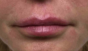 Real Patient Lip Augmentation, Somenek + Pittman MD, Washington D.C.
