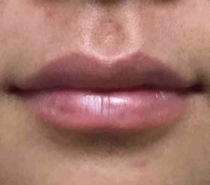 Real Patient Lip Augmentation, Somenek + Pittman MD, Washington D.C.