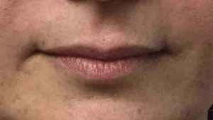 Real Patient Lip Augmentation, Somenek + Pittman MD, Washington D.C.