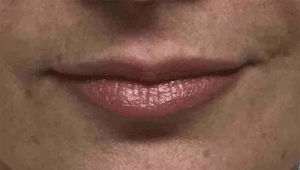 Real Patient Lip Augmentation, Somenek + Pittman MD, Washington D.C.