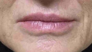 Real Patient Lip Augmentation, Somenek + Pittman MD, Washington D.C.