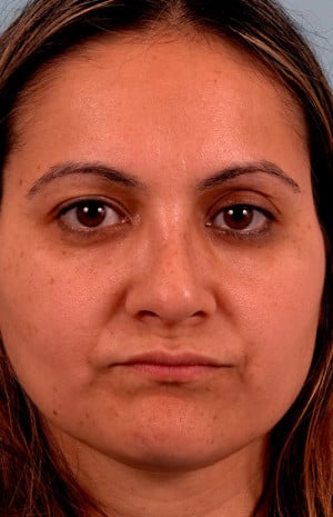 Real patient Rhinoplasty by Dr.Somenek, Washington D.C.