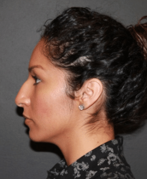 Real patient Rhinoplasty by Dr.Somenek, Washington D.C.