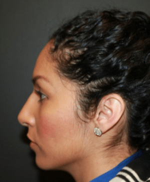Real patient Rhinoplasty by Dr.Somenek, Washington D.C.
