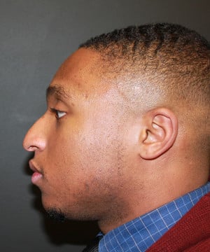 Real patient Rhinoplasty by Dr.Somenek, Washington D.C.
