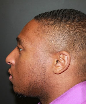 Real patient Rhinoplasty by Dr.Somenek, Washington D.C.