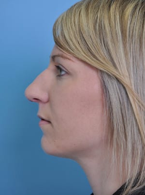 Real patient Rhinoplasty by Dr.Somenek, Washington D.C.