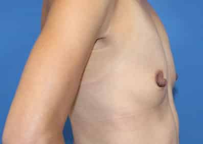 Real patient NIpple Reduction by Dr.Pittman, Washington D.C.
