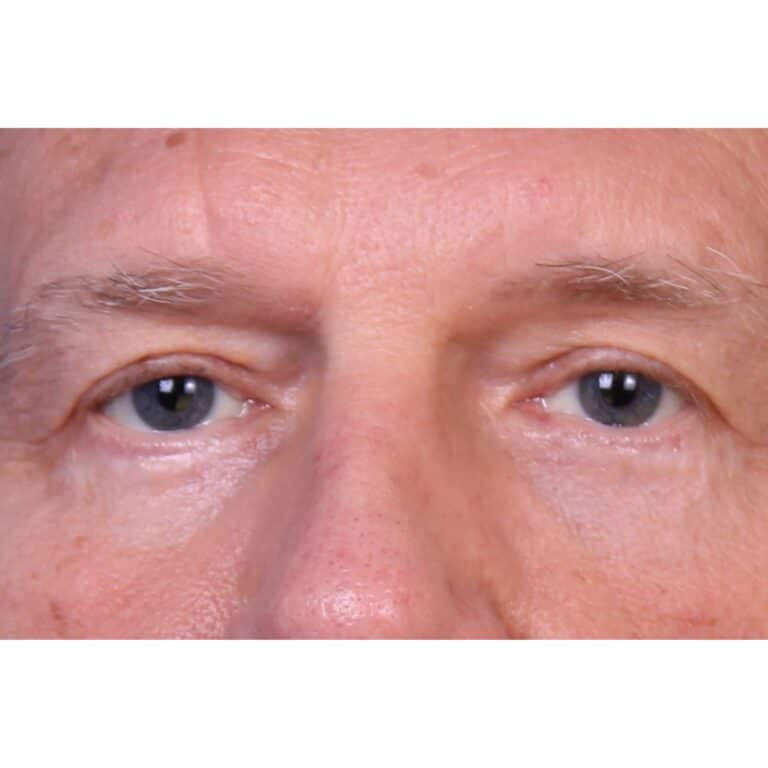 Real patient Blepharoplasty by Dr.Somenek, Washington D.C.