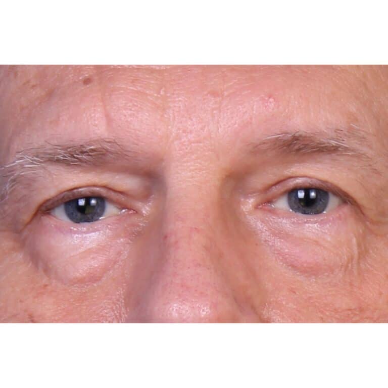 Real patient Blepharoplasty by Dr.Somenek, Washington D.C.