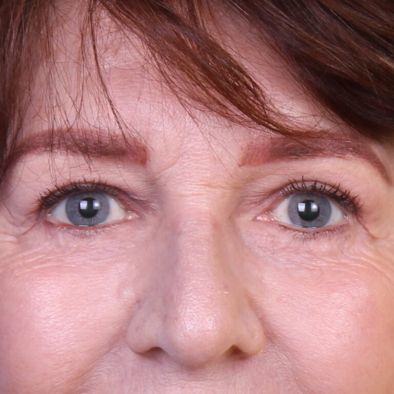 Real patient Blepharoplasty by Dr.Somenek, Washington D.C.