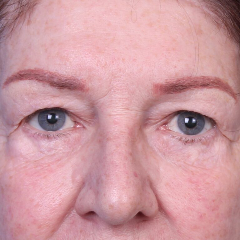 Real patient Blepharoplasty by Dr.Somenek, Washington D.C.