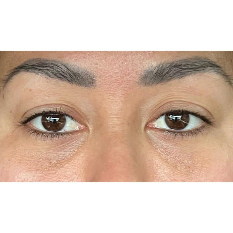 Real patient Blepharoplasty by Dr.Somenek, Washington D.C.