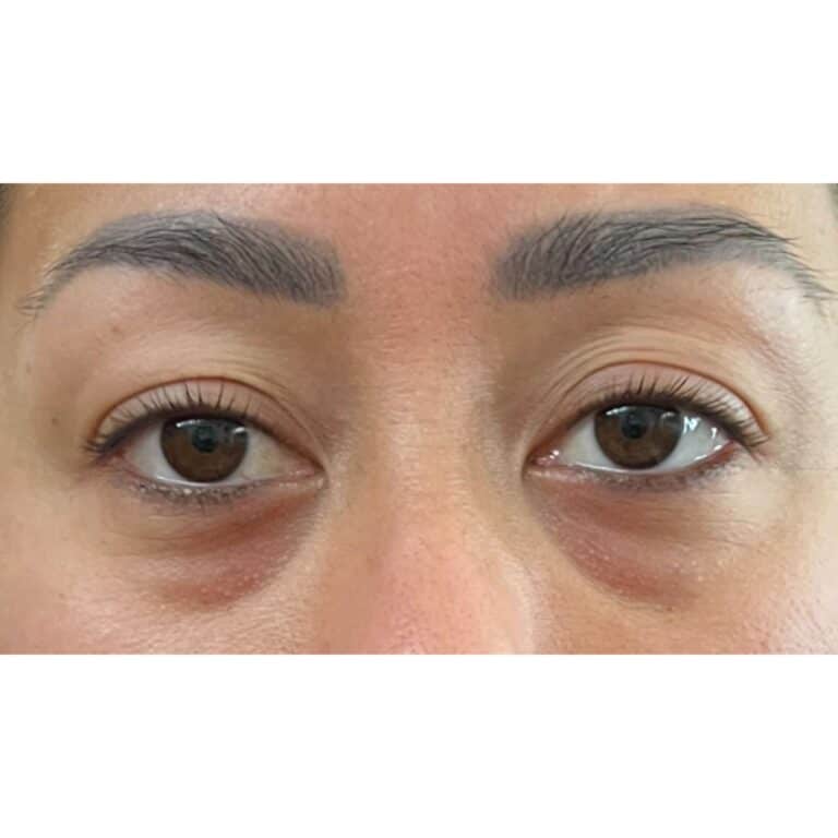 Real patient Blepharoplasty by Dr.Somenek, Washington D.C.