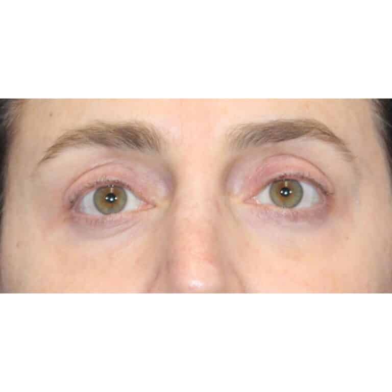 Real patient Blepharoplasty by Dr.Somenek, Washington D.C.