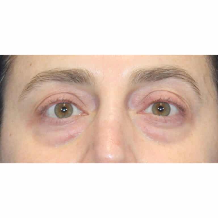 Real patient Blepharoplasty by Dr.Somenek, Washington D.C.