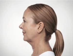 Kybella, Somenek + Pittman MD, Washington D.C.